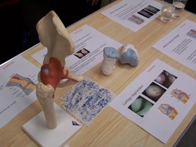 picture of Artificial Replacement for Cartilage in a Human Joint